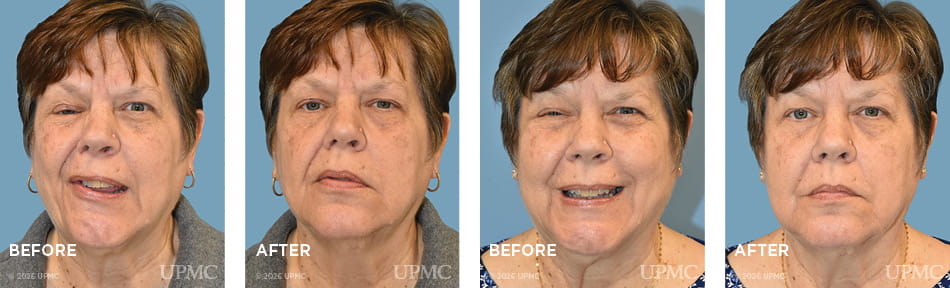 Selective denervation, DAO resection, and fascia lata for nasal valve repair for right facial synkinesis due to Ramsay Hunt syndrome.